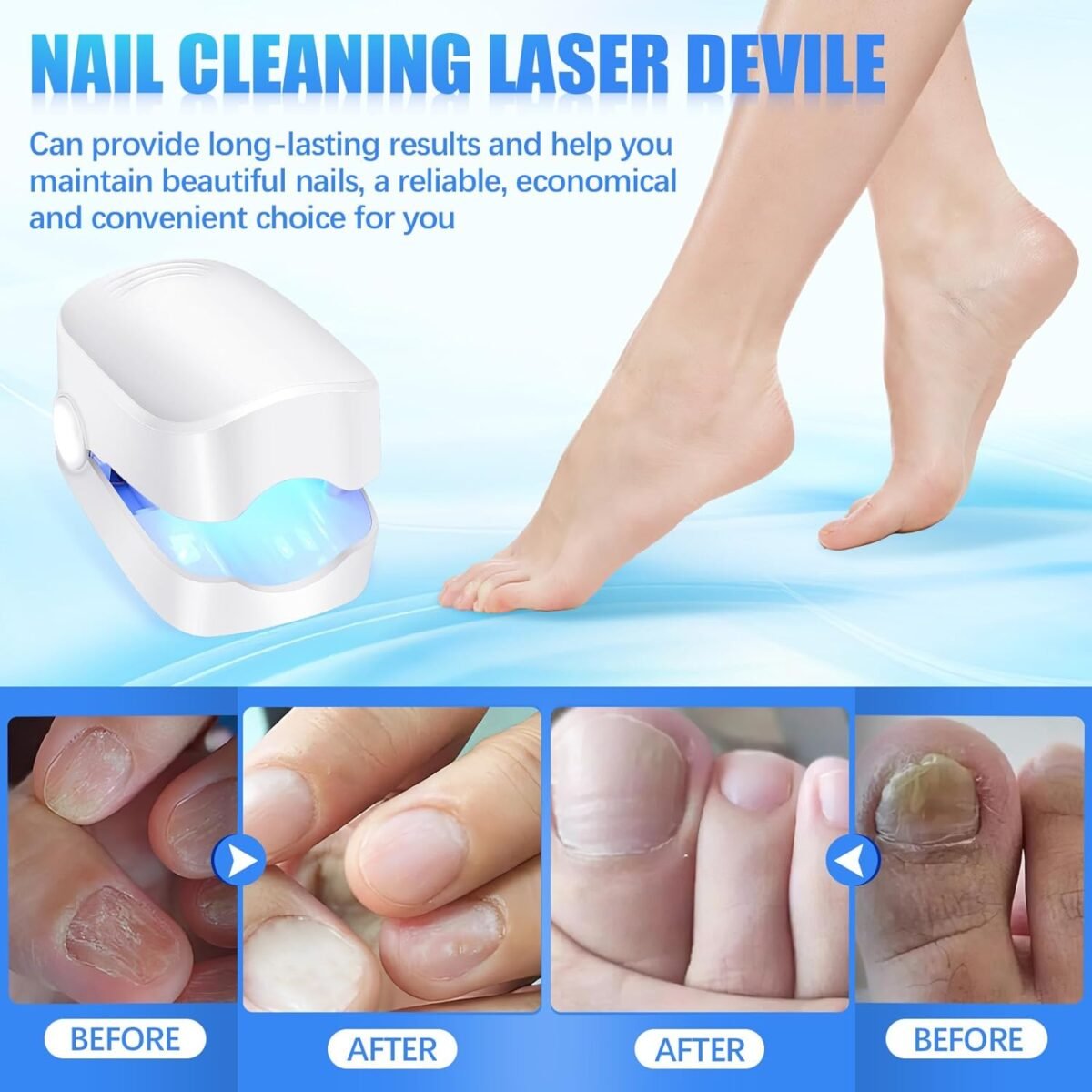 Rechargeable Nail Fungus Laser – Anti-Fungal Device for Toenails, Hands & Feet (Home Use) - Image 5